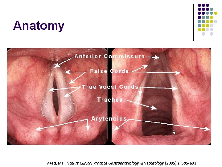 Anatomy Vaezi, MF. Nature Clinical Practice Gastroenterology & Hepatology (2005) 2, 595 -603 