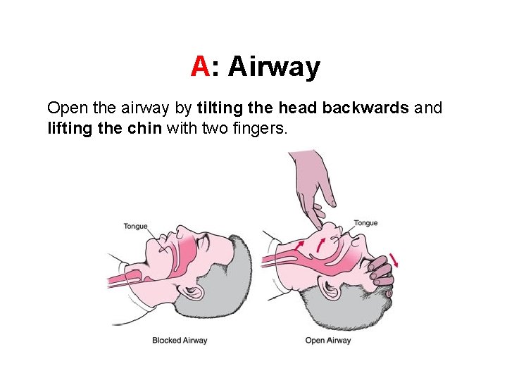 A: Airway Open the airway by tilting the head backwards and lifting the chin