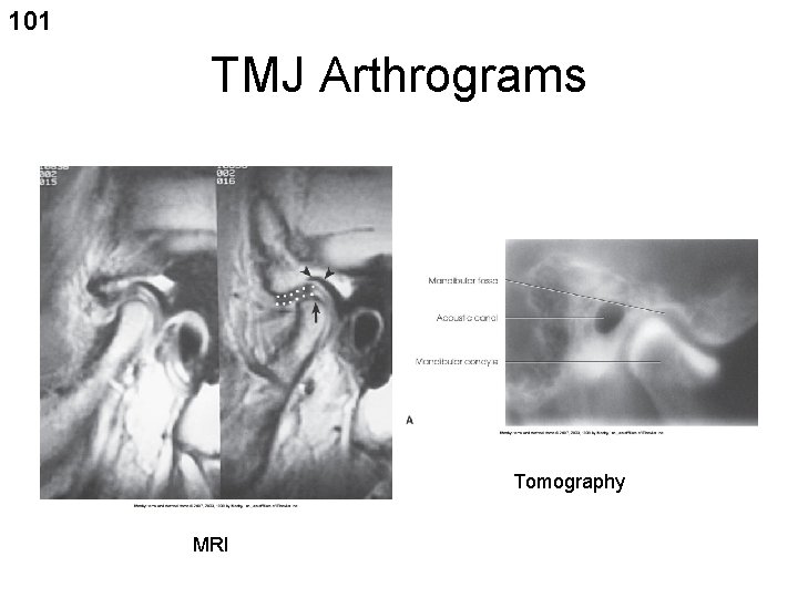 101 TMJ Arthrograms Tomography MRI 