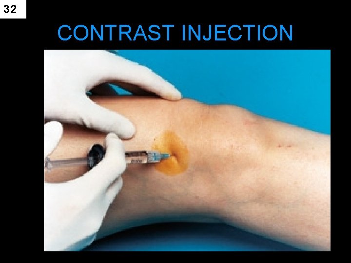 32 CONTRAST INJECTION 
