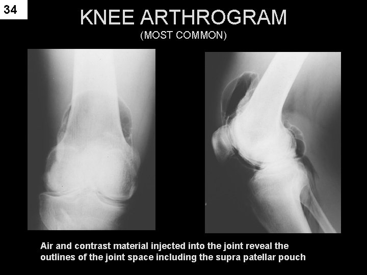 34 KNEE ARTHROGRAM (MOST COMMON) Air and contrast material injected into the joint reveal
