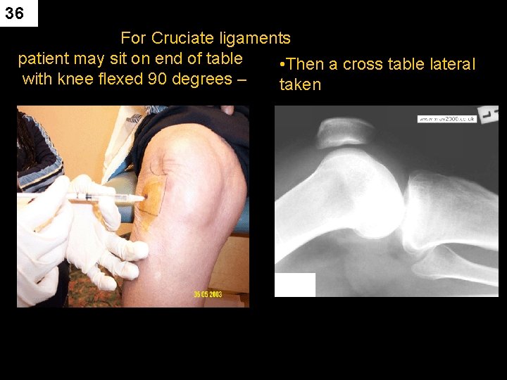 36 For Cruciate ligaments patient may sit on end of table • Then a