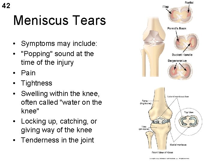 42 Meniscus Tears • Symptoms may include: • "Popping" sound at the time of