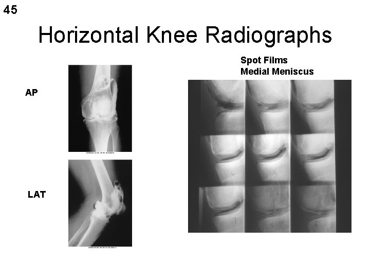 45 Horizontal Knee Radiographs Spot Films Medial Meniscus AP LAT 
