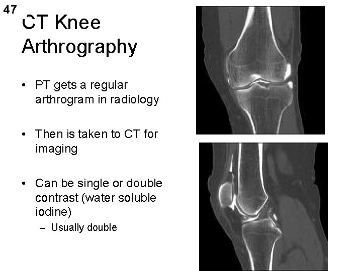 47 CT Knee Arthrography • PT gets a regular arthrogram in radiology • Then