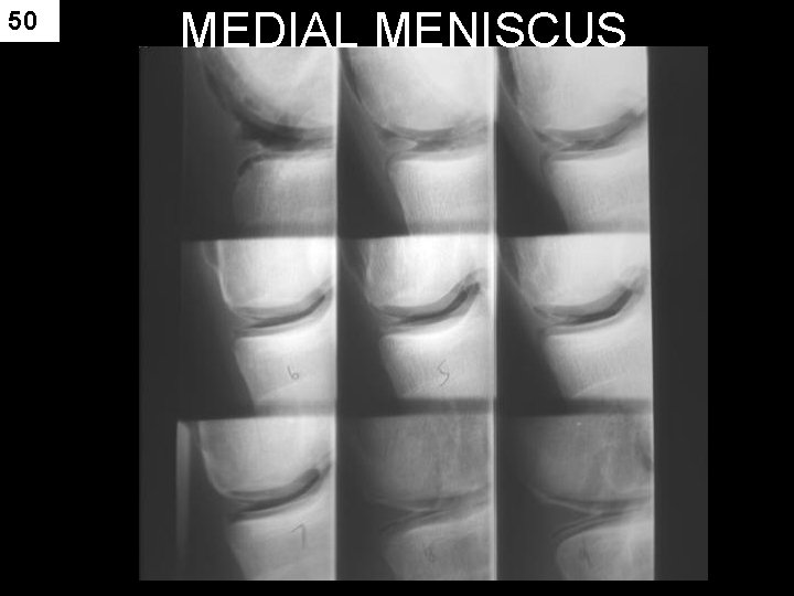 50 MEDIAL MENISCUS 