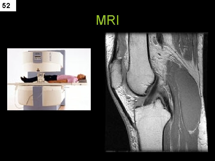 52 MRI 