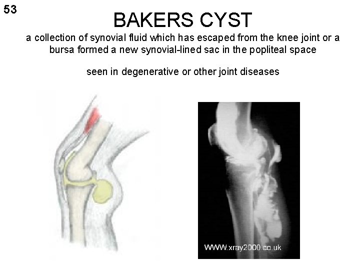 53 BAKERS CYST a collection of synovial fluid which has escaped from the knee
