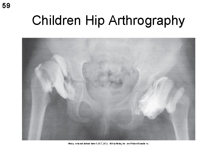 59 Children Hip Arthrography 