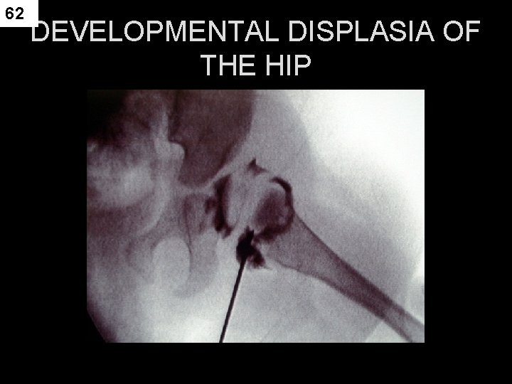 62 DEVELOPMENTAL DISPLASIA OF THE HIP 