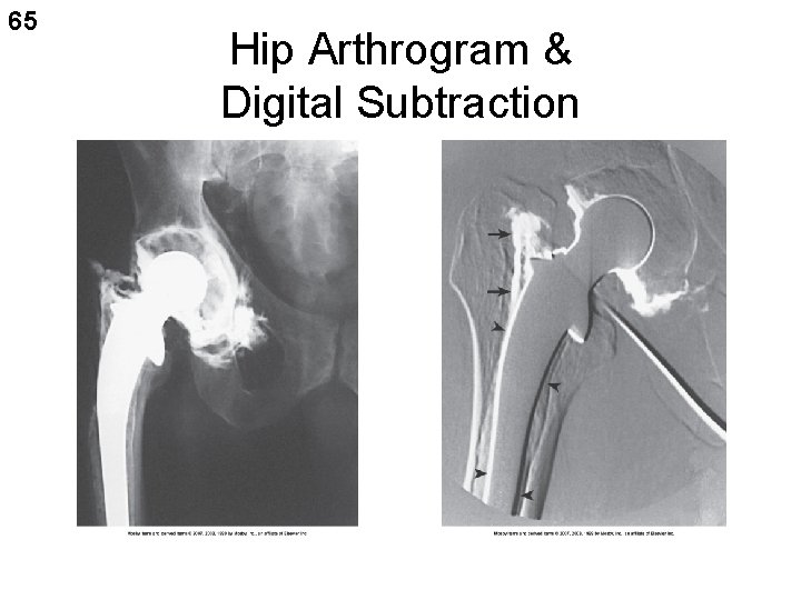 65 Hip Arthrogram & Digital Subtraction 