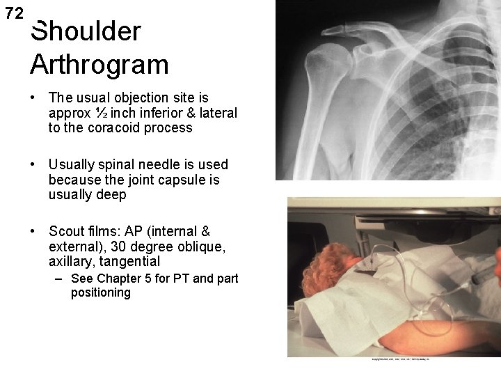 72 Shoulder Arthrogram • The usual objection site is approx ½ inch inferior &