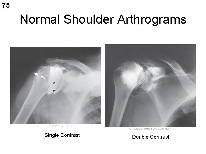 75 Normal Shoulder Arthrograms Single Contrast Double Contrast 