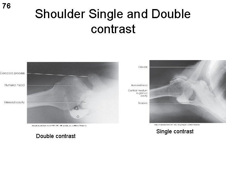 76 Shoulder Single and Double contrast Single contrast 