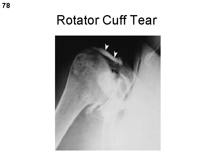 78 Rotator Cuff Tear 