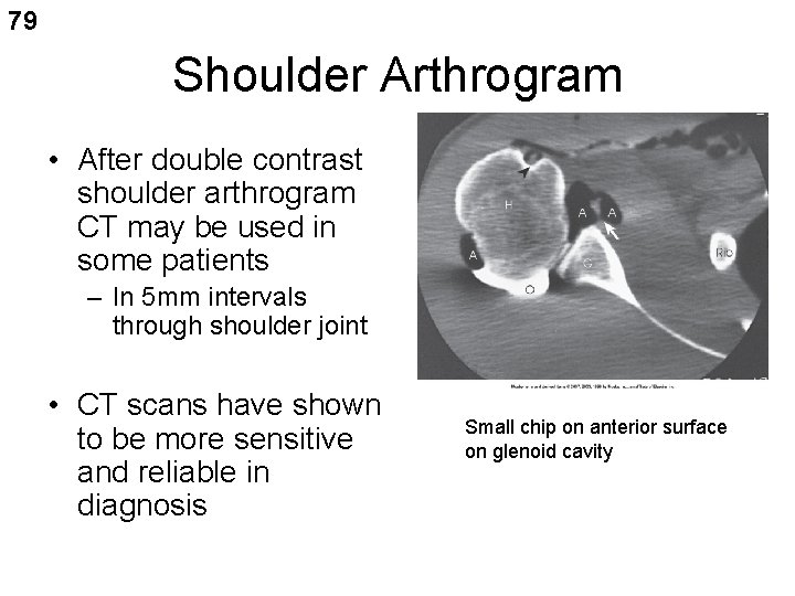 79 Shoulder Arthrogram • After double contrast shoulder arthrogram CT may be used in