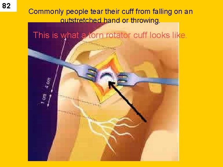 82 Commonly people tear their cuff from falling on an outstretched hand or throwing.