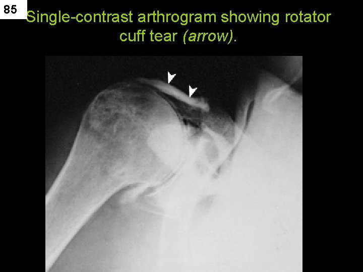 85 Single-contrast arthrogram showing rotator cuff tear (arrow). 