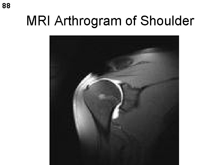 88 MRI Arthrogram of Shoulder 