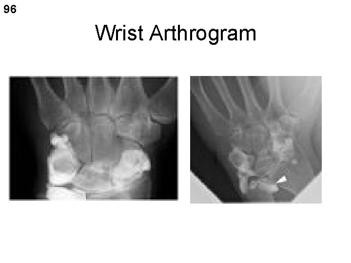 96 Wrist Arthrogram 