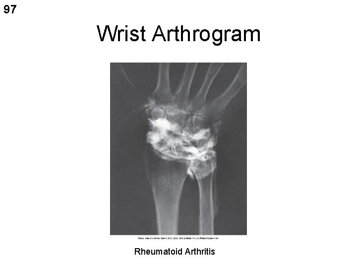 97 Wrist Arthrogram Rheumatoid Arthritis 