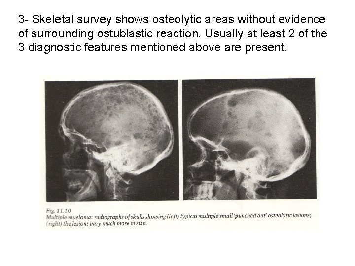 3 - Skeletal survey shows osteolytic areas without evidence of surrounding ostublastic reaction. Usually