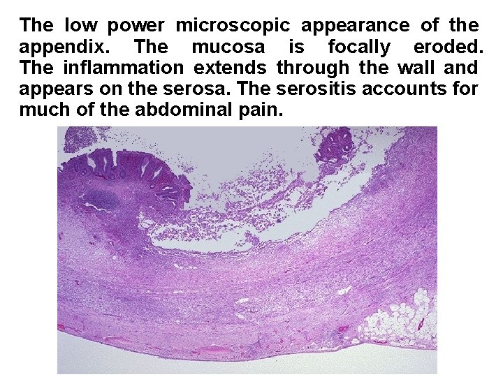 The low power microscopic appearance of the appendix. The mucosa is focally eroded. The The low power microscopic appearance of the appendix. The mucosa is focally eroded. The