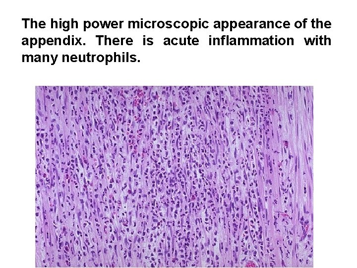 The high power microscopic appearance of the appendix. There is acute inflammation with many The high power microscopic appearance of the appendix. There is acute inflammation with many