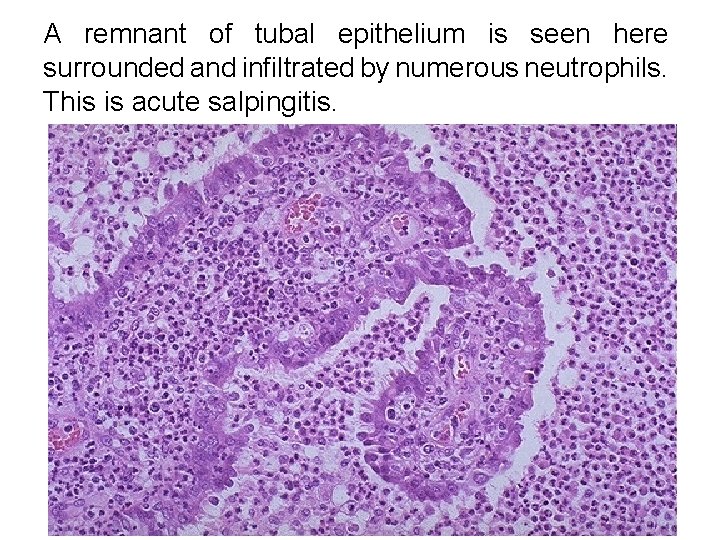 A remnant of tubal epithelium is seen here surrounded and infiltrated by numerous neutrophils. A remnant of tubal epithelium is seen here surrounded and infiltrated by numerous neutrophils.