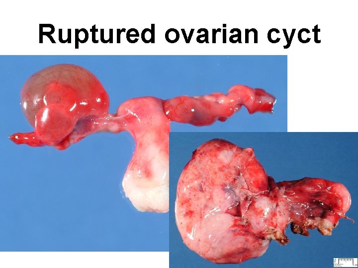 Ruptured ovarian cyct Ruptured ovarian cyct