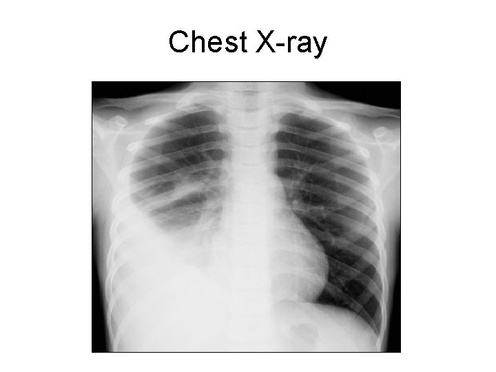 Chest X-ray Chest X-ray