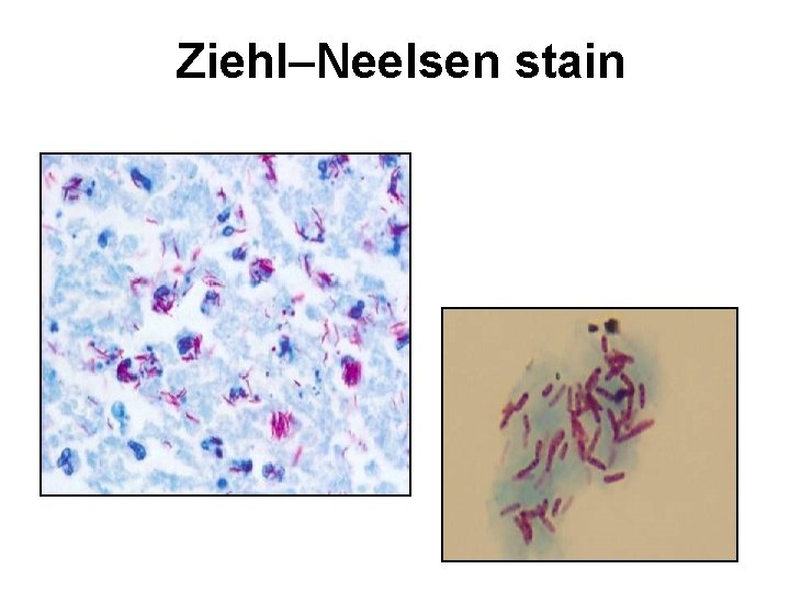 Ziehl–Neelsen stain Ziehl–Neelsen stain