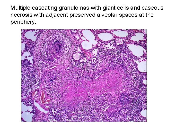Multiple caseating granulomas with giant cells and caseous necrosis with adjacent preserved alveolar spaces Multiple caseating granulomas with giant cells and caseous necrosis with adjacent preserved alveolar spaces