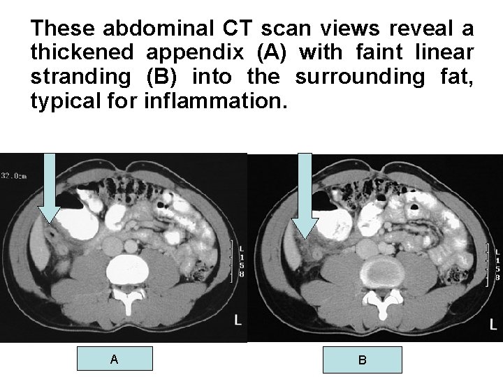 These abdominal CT scan views reveal a thickened appendix (A) with faint linear stranding These abdominal CT scan views reveal a thickened appendix (A) with faint linear stranding