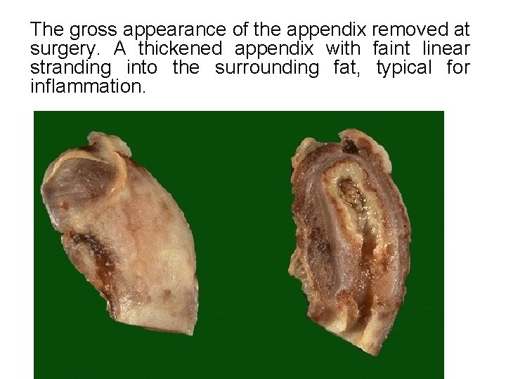 The gross appearance of the appendix removed at surgery. A thickened appendix with faint The gross appearance of the appendix removed at surgery. A thickened appendix with faint