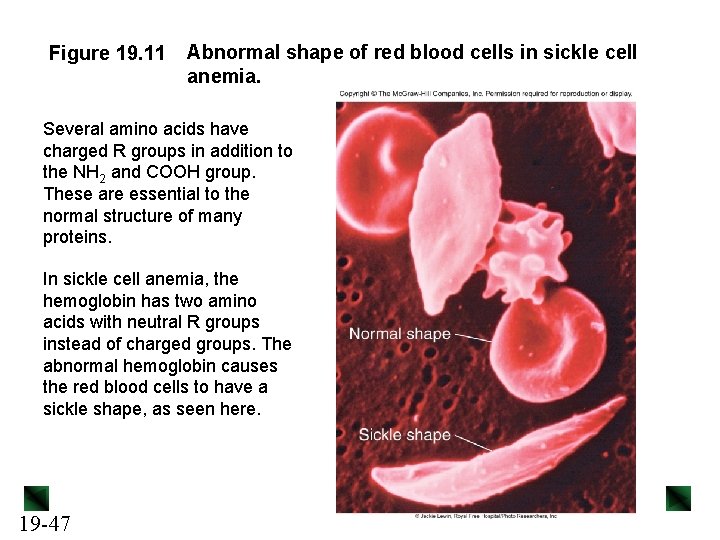 Figure 19. 11 Abnormal shape of red blood cells in sickle cell anemia. Several