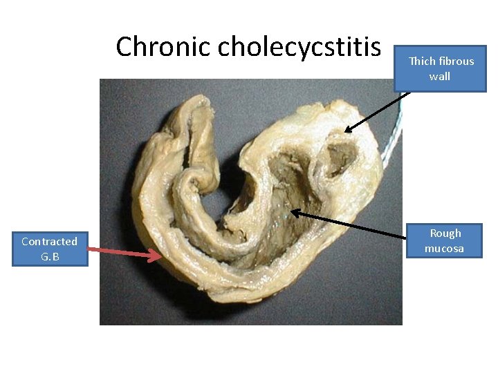 Chronic cholecycstitis Contracted G. B Thich fibrous wall Rough mucosa 