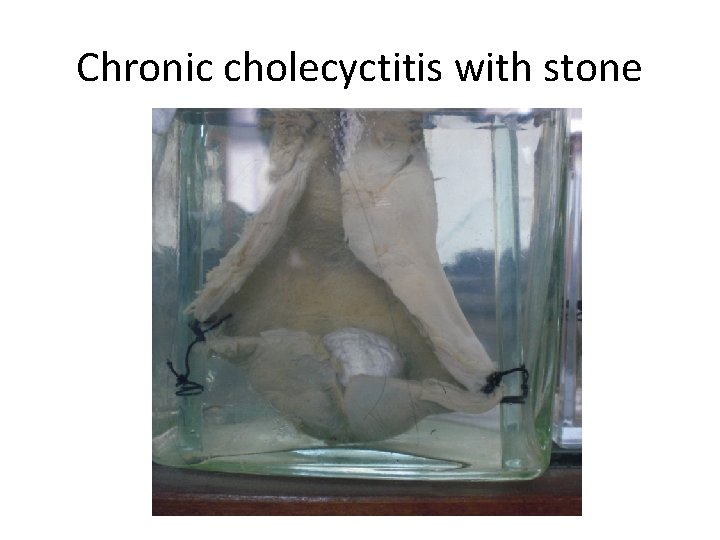 Chronic cholecyctitis with stone 