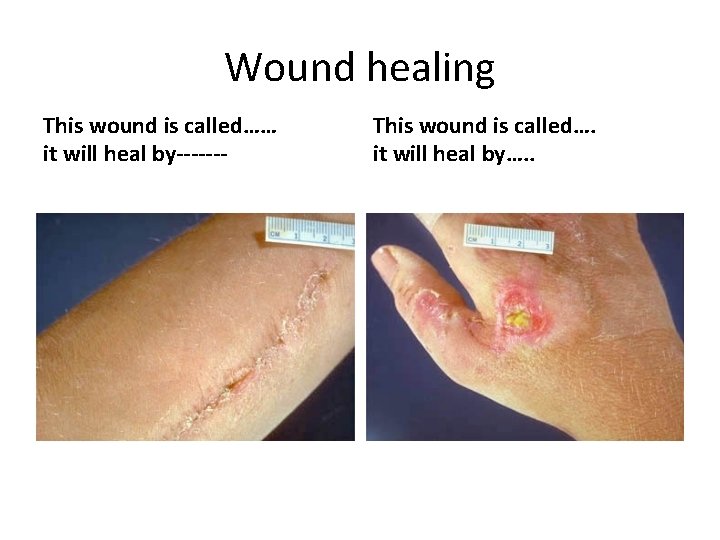 Wound healing This wound is called…… it will heal by------- This wound is called….