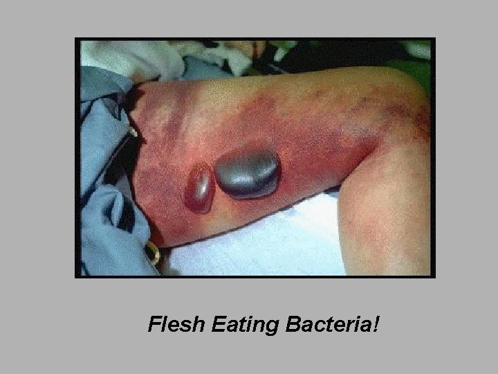 Flesh Eating Bacteria! 