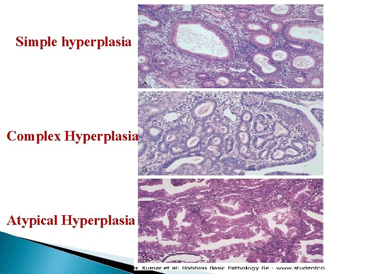 Simple hyperplasia Complex Hyperplasia Atypical Hyperplasia 