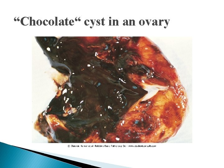 “Chocolate“ cyst in an ovary 