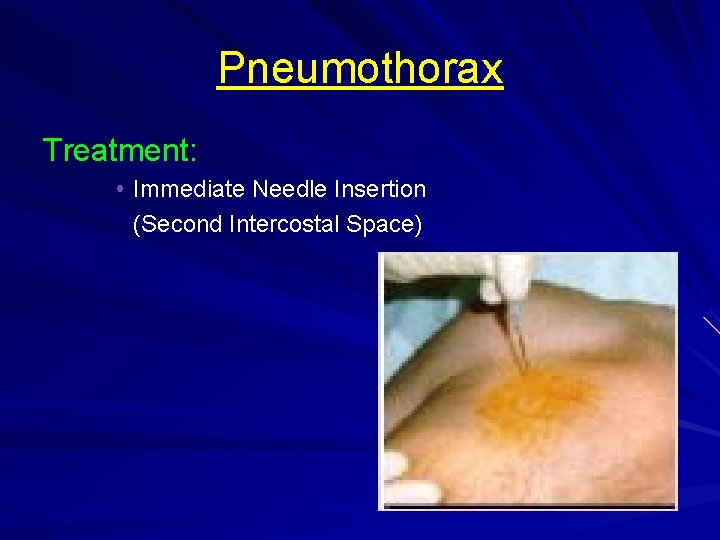 Pneumothorax Treatment: Immediate Needle Insertion (Second Intercostal Space) 
