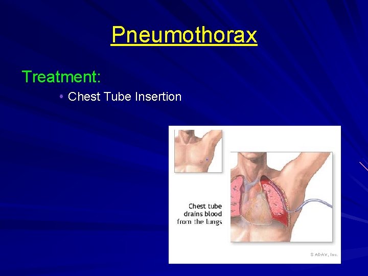 Pneumothorax Treatment: Chest Tube Insertion 