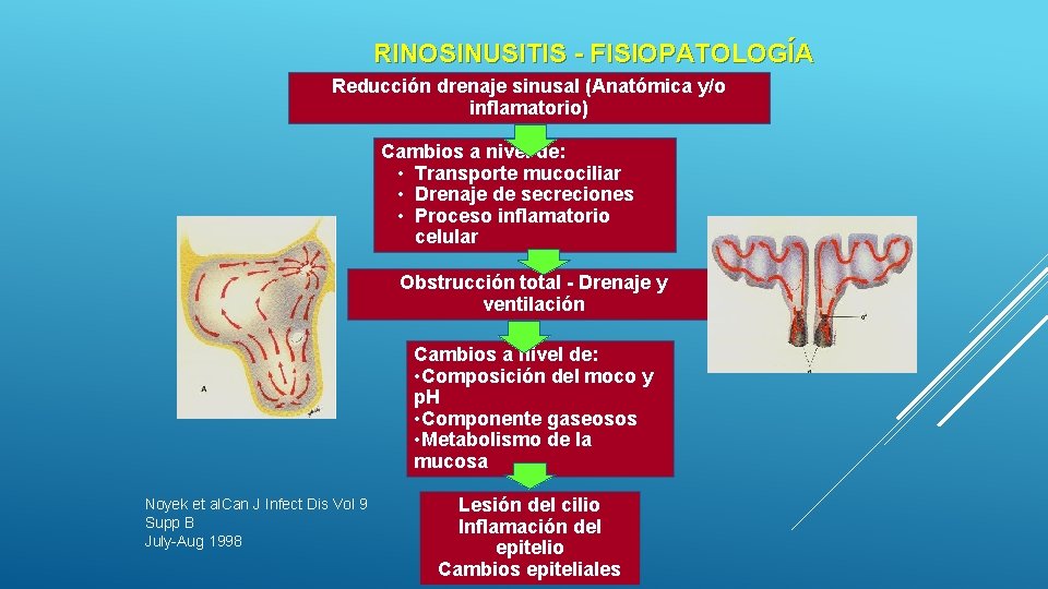 RINOSINUSITIS - FISIOPATOLOGÍA Reducción drenaje sinusal (Anatómica y/o inflamatorio) Cambios a nivel de: • RINOSINUSITIS - FISIOPATOLOGÍA Reducción drenaje sinusal (Anatómica y/o inflamatorio) Cambios a nivel de: •