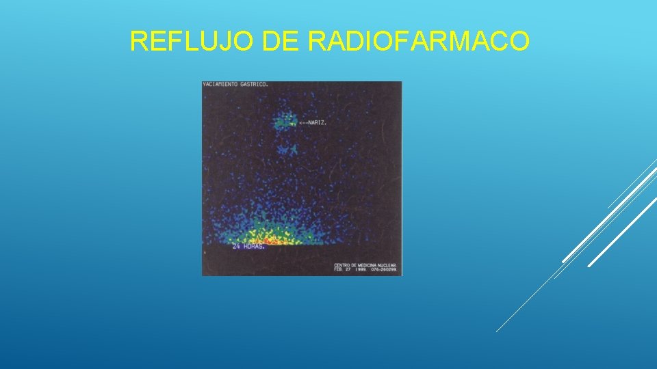 REFLUJO DE RADIOFARMACO REFLUJO DE RADIOFARMACO
