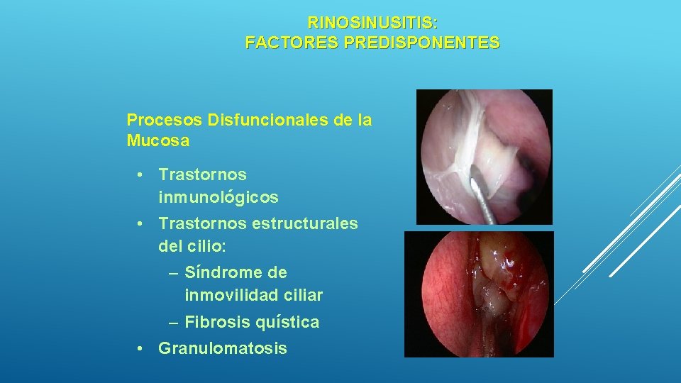 RINOSINUSITIS: FACTORES PREDISPONENTES Procesos Disfuncionales de la Mucosa • Trastornos inmunológicos • Trastornos estructurales RINOSINUSITIS: FACTORES PREDISPONENTES Procesos Disfuncionales de la Mucosa • Trastornos inmunológicos • Trastornos estructurales