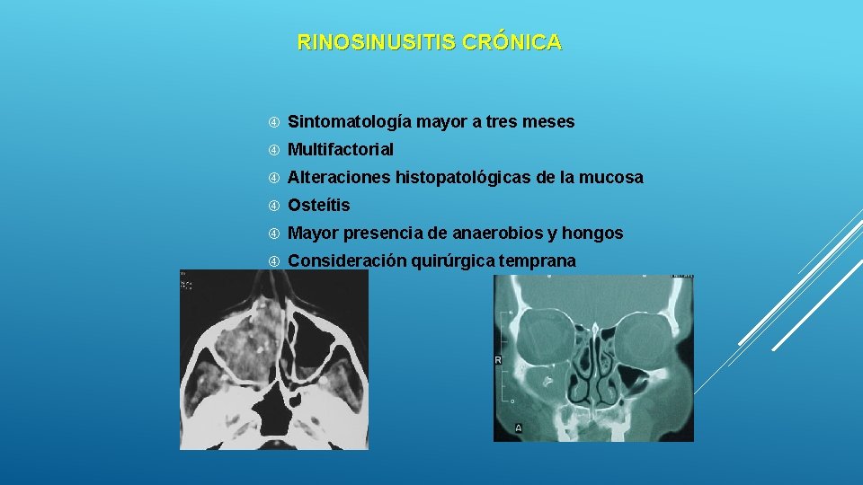 RINOSINUSITIS CRÓNICA Sintomatología mayor a tres meses Multifactorial Alteraciones histopatológicas de la mucosa Osteítis RINOSINUSITIS CRÓNICA Sintomatología mayor a tres meses Multifactorial Alteraciones histopatológicas de la mucosa Osteítis