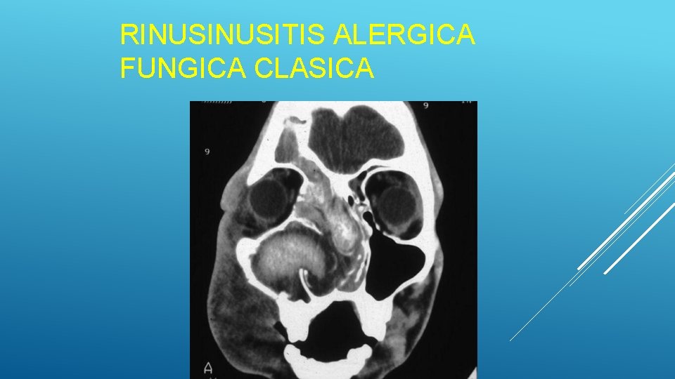 RINUSITIS ALERGICA FUNGICA CLASICA RINUSITIS ALERGICA FUNGICA CLASICA