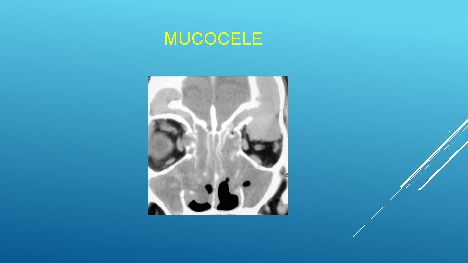 MUCOCELE MUCOCELE
